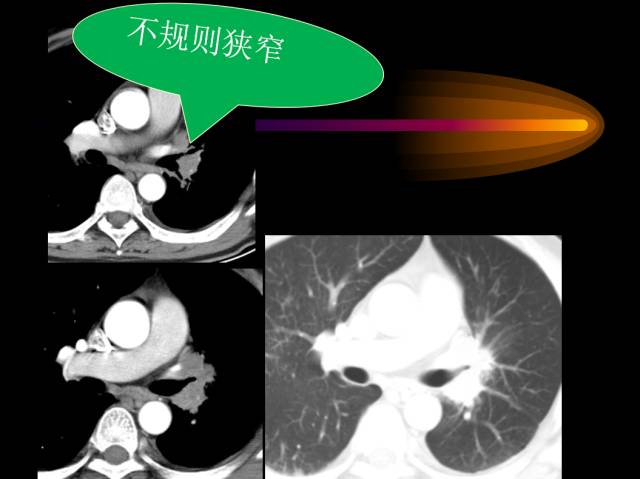 【PPT】肺肿瘤