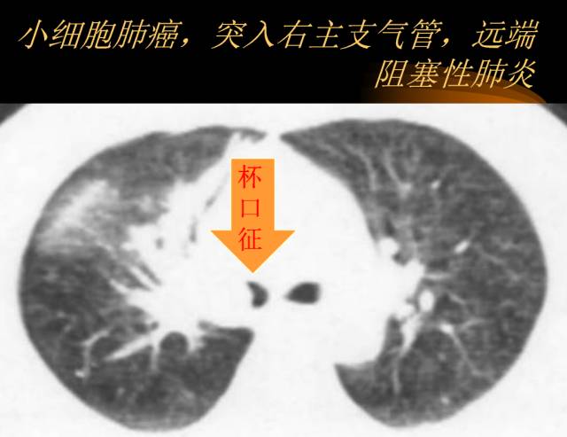 【PPT】肺肿瘤