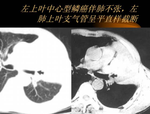 【PPT】肺肿瘤
