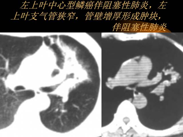 【PPT】肺肿瘤