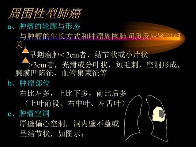 【PPT】肺肿瘤