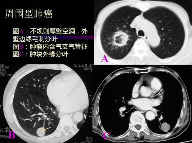 【PPT】肺肿瘤