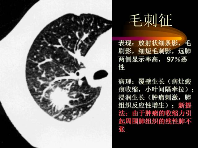 【PPT】肺肿瘤