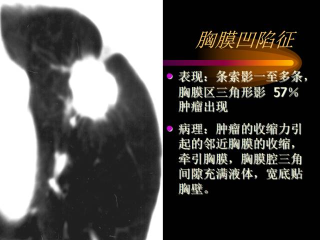 【PPT】肺肿瘤
