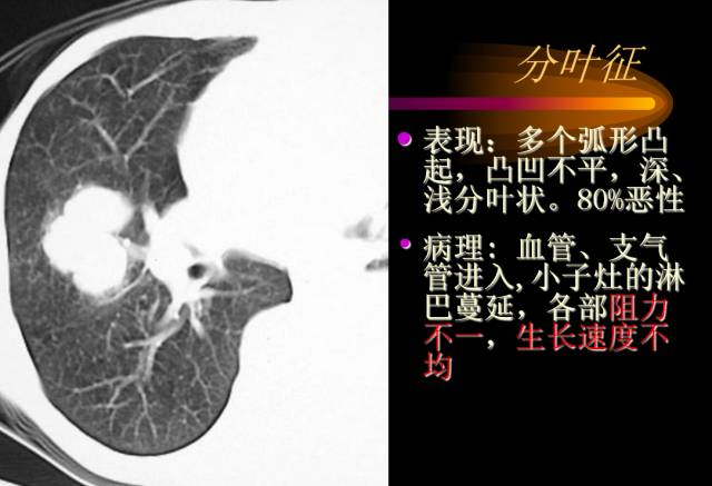 【PPT】肺肿瘤