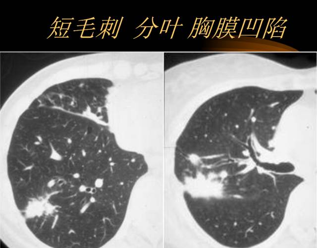 【PPT】肺肿瘤