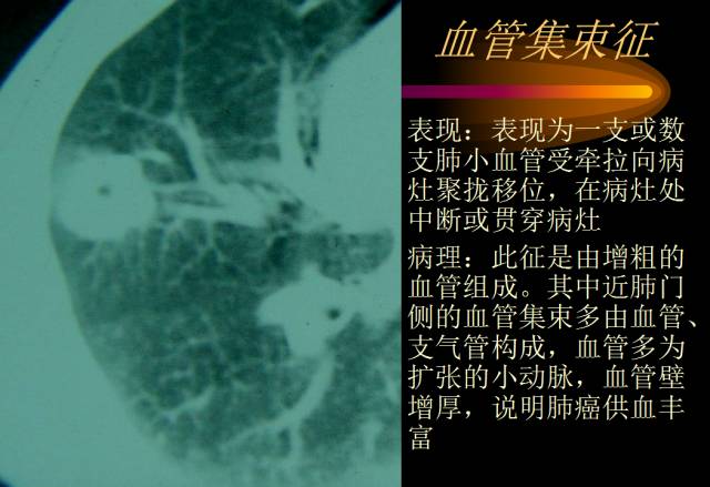 【PPT】肺肿瘤