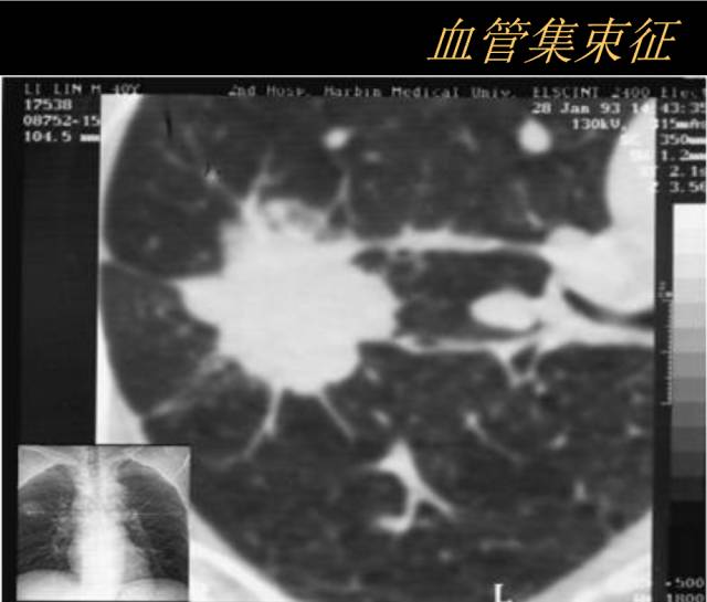 【PPT】肺肿瘤