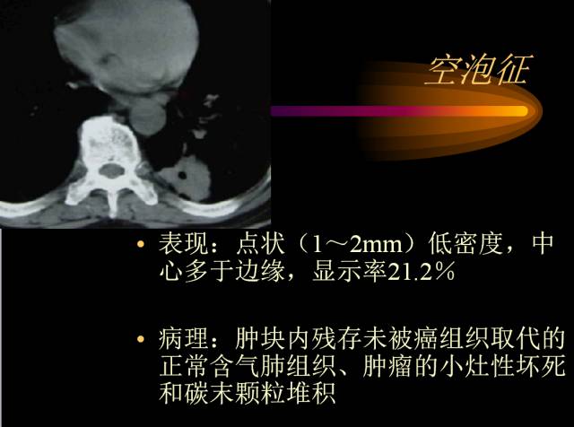 【PPT】肺肿瘤