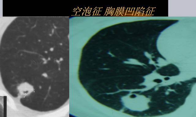 【PPT】肺肿瘤