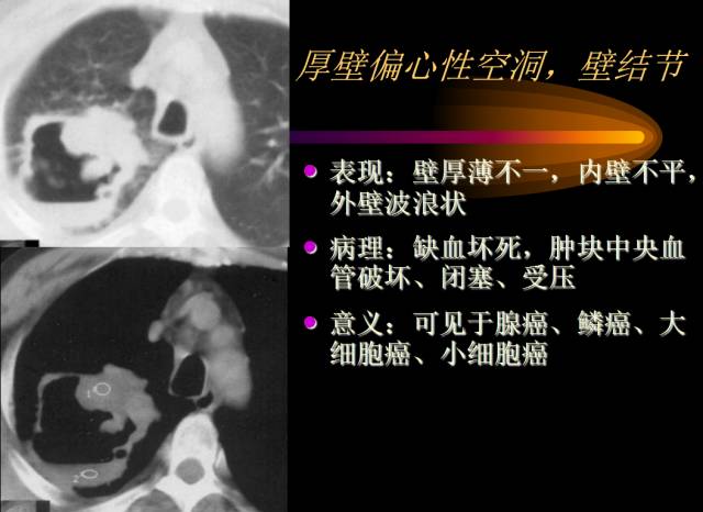 【PPT】肺肿瘤