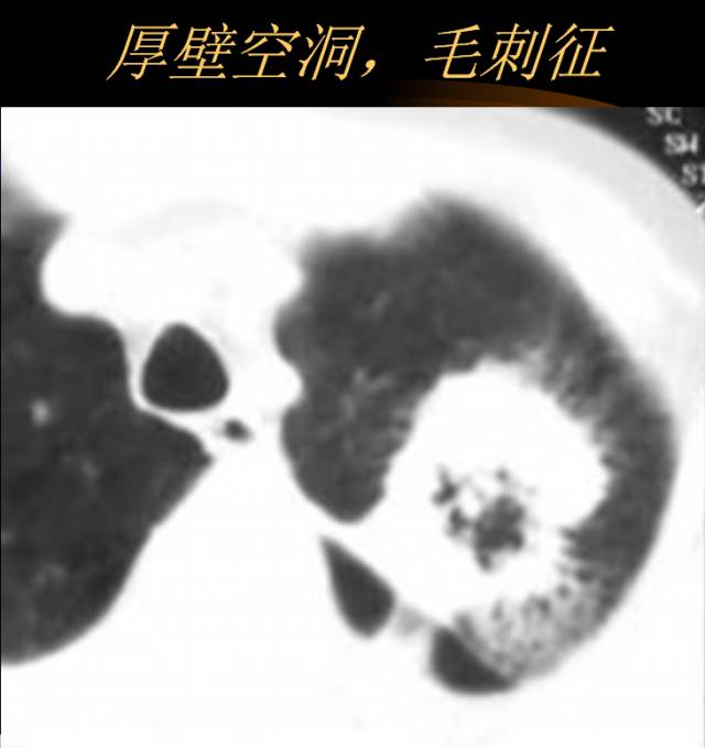 【PPT】肺肿瘤