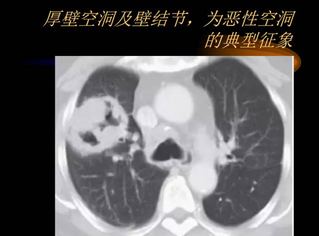 【PPT】肺肿瘤