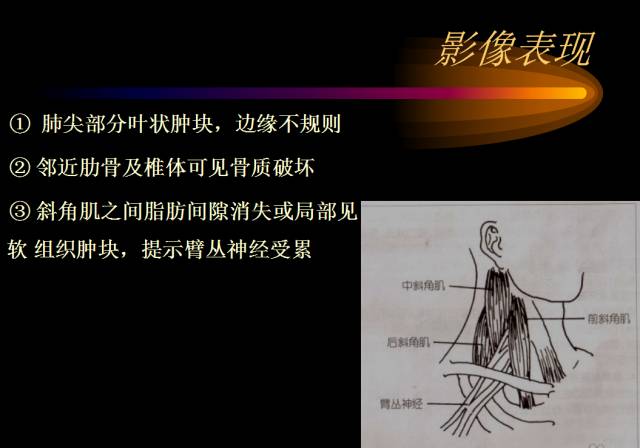 【PPT】肺肿瘤