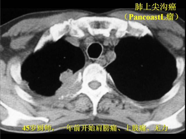 【PPT】肺肿瘤
