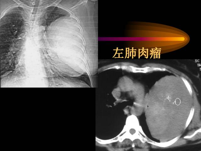 【PPT】肺肿瘤