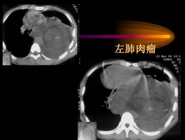 【PPT】肺肿瘤
