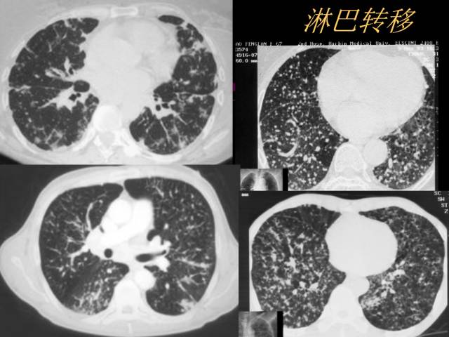 【PPT】肺肿瘤