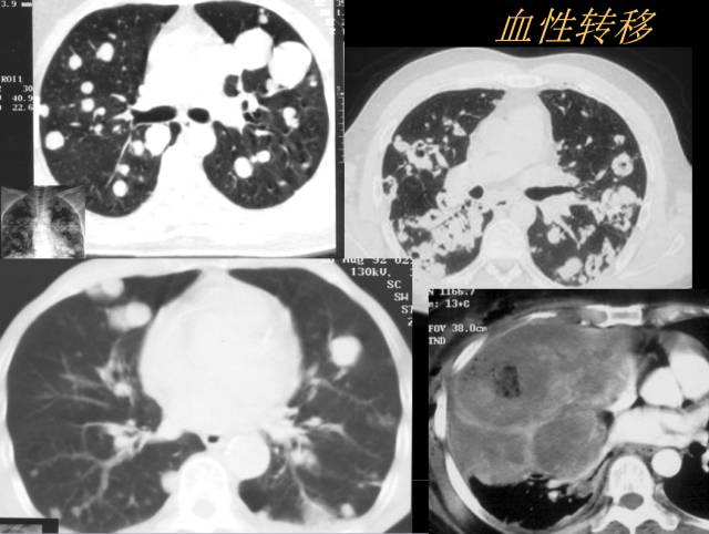 【PPT】肺肿瘤