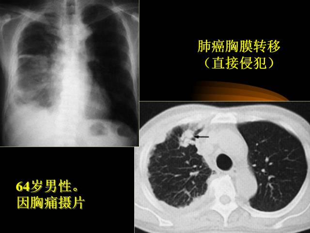 【PPT】肺肿瘤