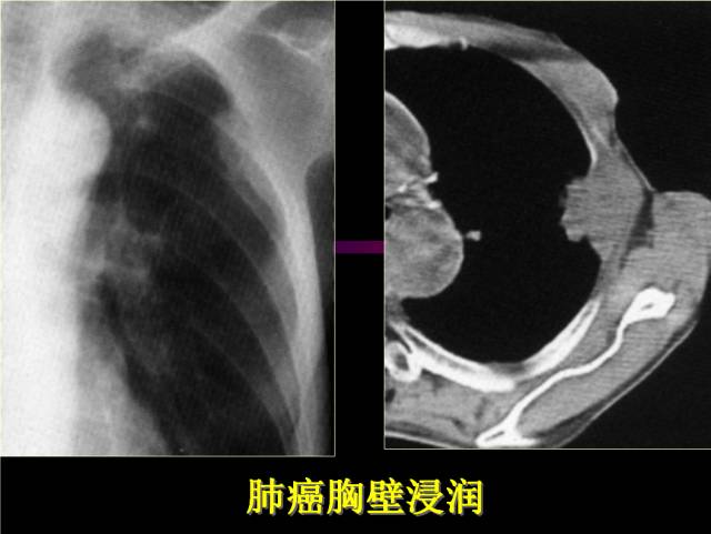 【PPT】肺肿瘤