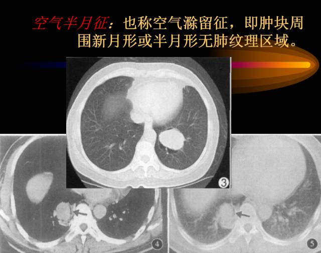 【PPT】肺肿瘤