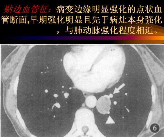 【PPT】肺肿瘤