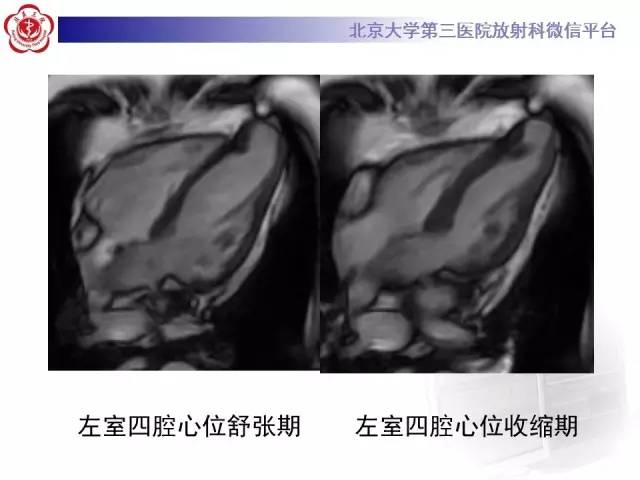 【病例】心脏憩室1例MR影像表现