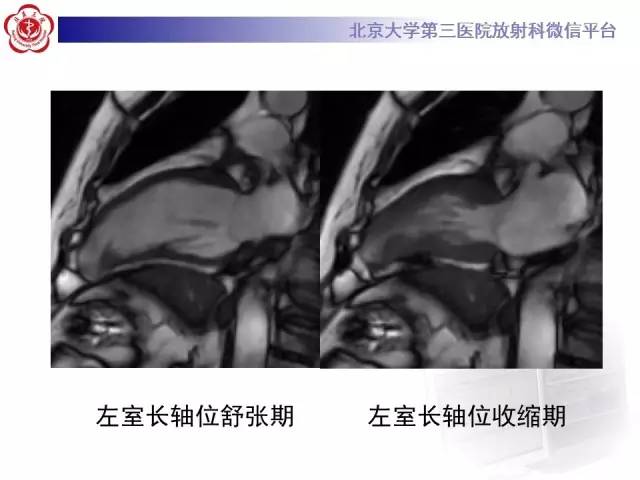 【病例】心脏憩室1例MR影像表现