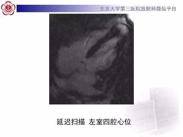 【病例】心脏憩室1例MR影像表现