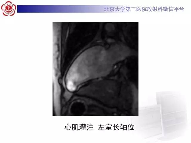 【病例】心脏憩室1例MR影像表现