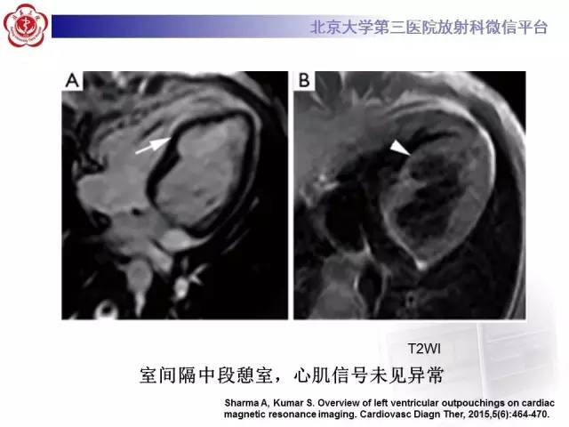 【病例】心脏憩室1例MR影像表现