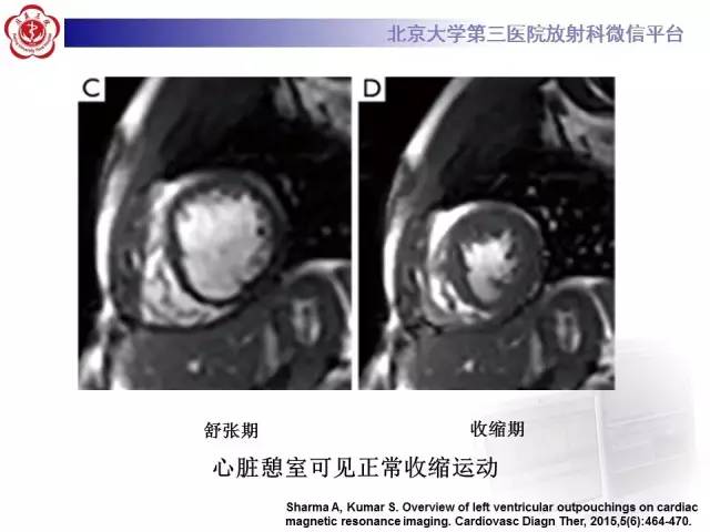 【病例】心脏憩室1例MR影像表现