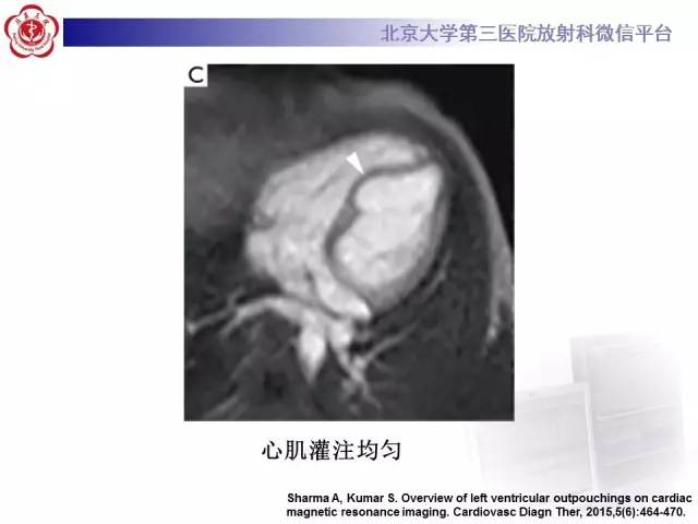 【病例】心脏憩室1例MR影像表现
