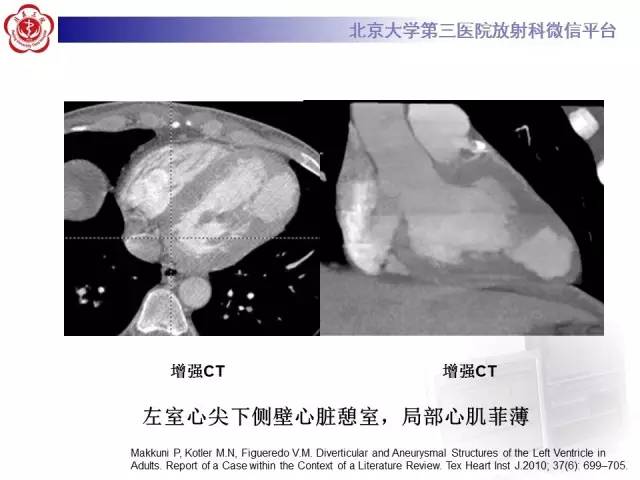 【病例】心脏憩室1例MR影像表现