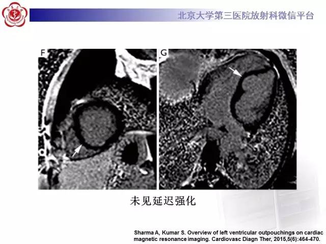 【病例】心脏憩室1例MR影像表现