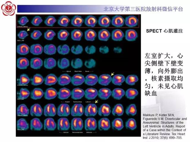 【病例】心脏憩室1例MR影像表现