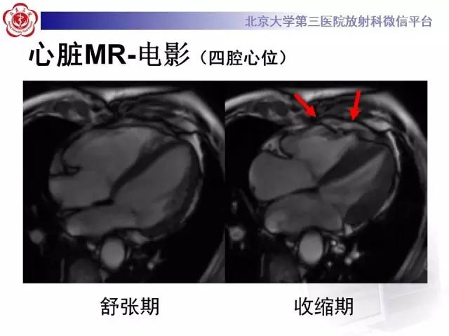 【病例】致心率失常性心肌病1例MR