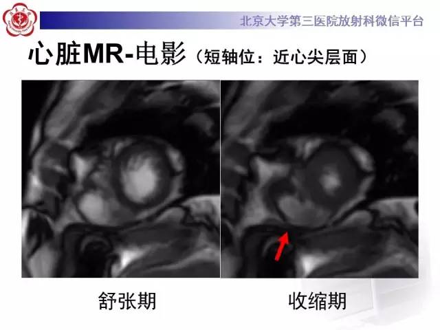 【病例】致心率失常性心肌病1例MR