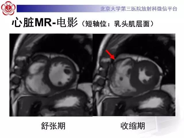 【病例】致心率失常性心肌病1例MR