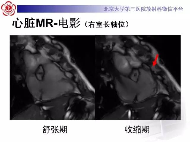 【病例】致心率失常性心肌病1例MR