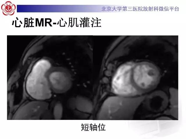 【病例】致心率失常性心肌病1例MR
