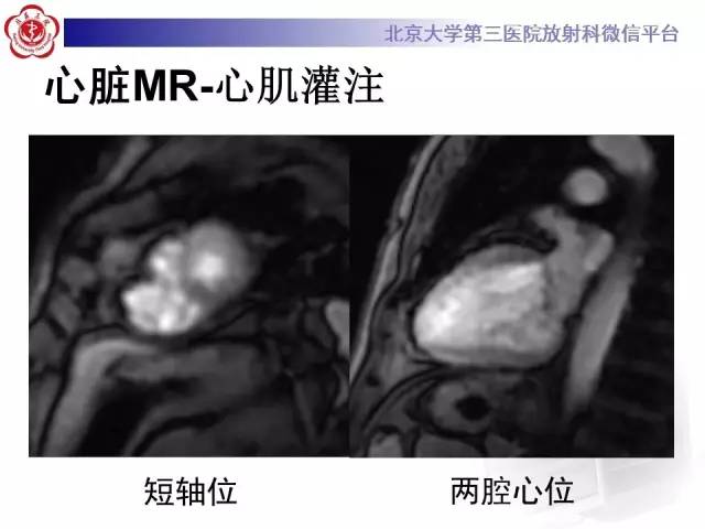 【病例】致心率失常性心肌病1例MR