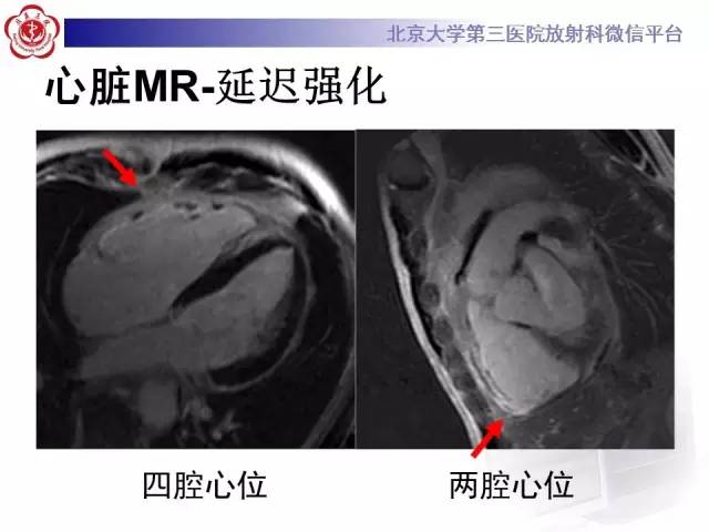【病例】致心率失常性心肌病1例MR