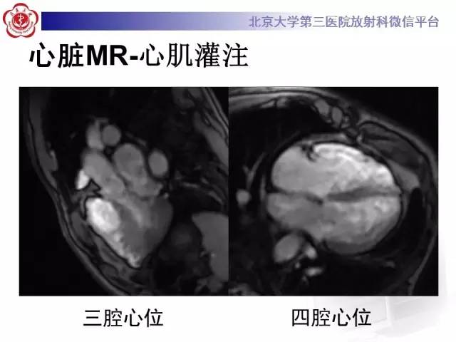 【病例】致心率失常性心肌病1例MR