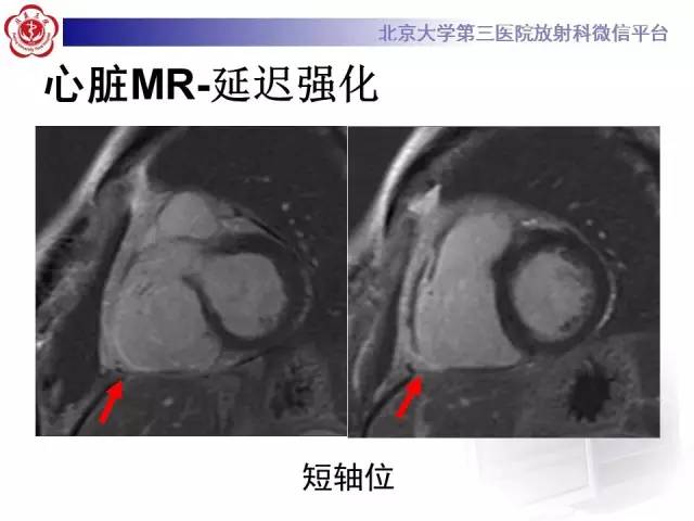 【病例】致心率失常性心肌病1例MR