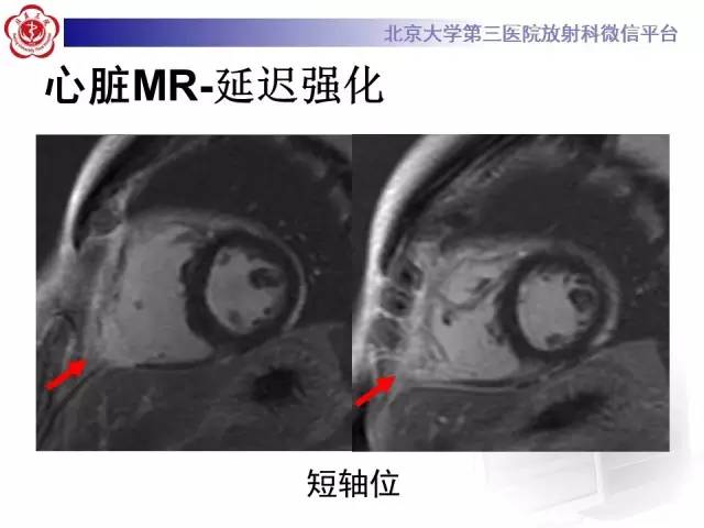 【病例】致心率失常性心肌病1例MR
