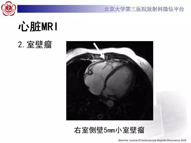 【病例】致心率失常性心肌病1例MR