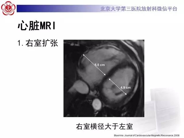 【病例】致心率失常性心肌病1例MR