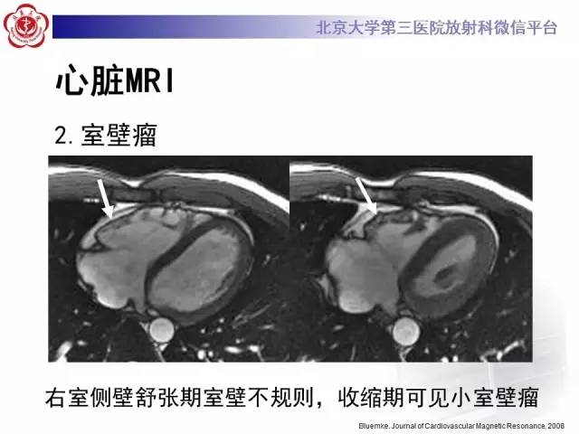 【病例】致心率失常性心肌病1例MR